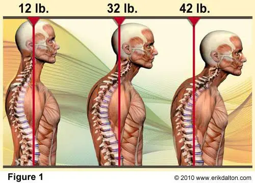 ForwardHeadPosture