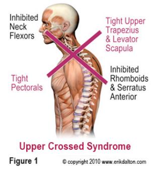 Upper Crossed Syndrome